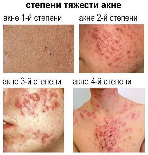 Степени тяжести акне