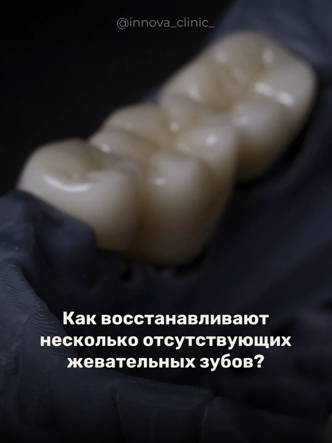 Вернули пациенту комфорт во время приёма пищи, а главное — восстановили правильную жева...