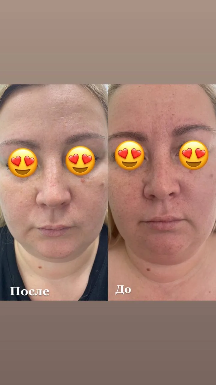 🙁Устали бороться с локальными жировыми отложениями?