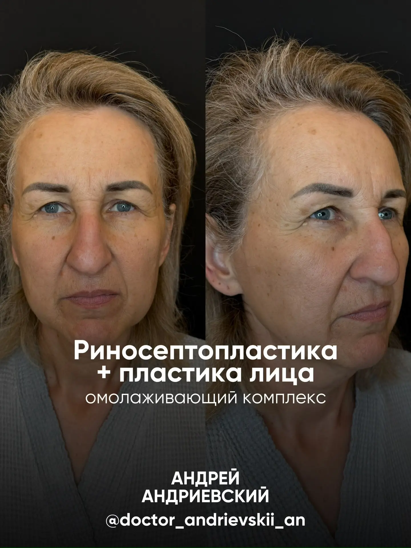 Скажу сразу: эта операция шла ШЕСТЬ часов.