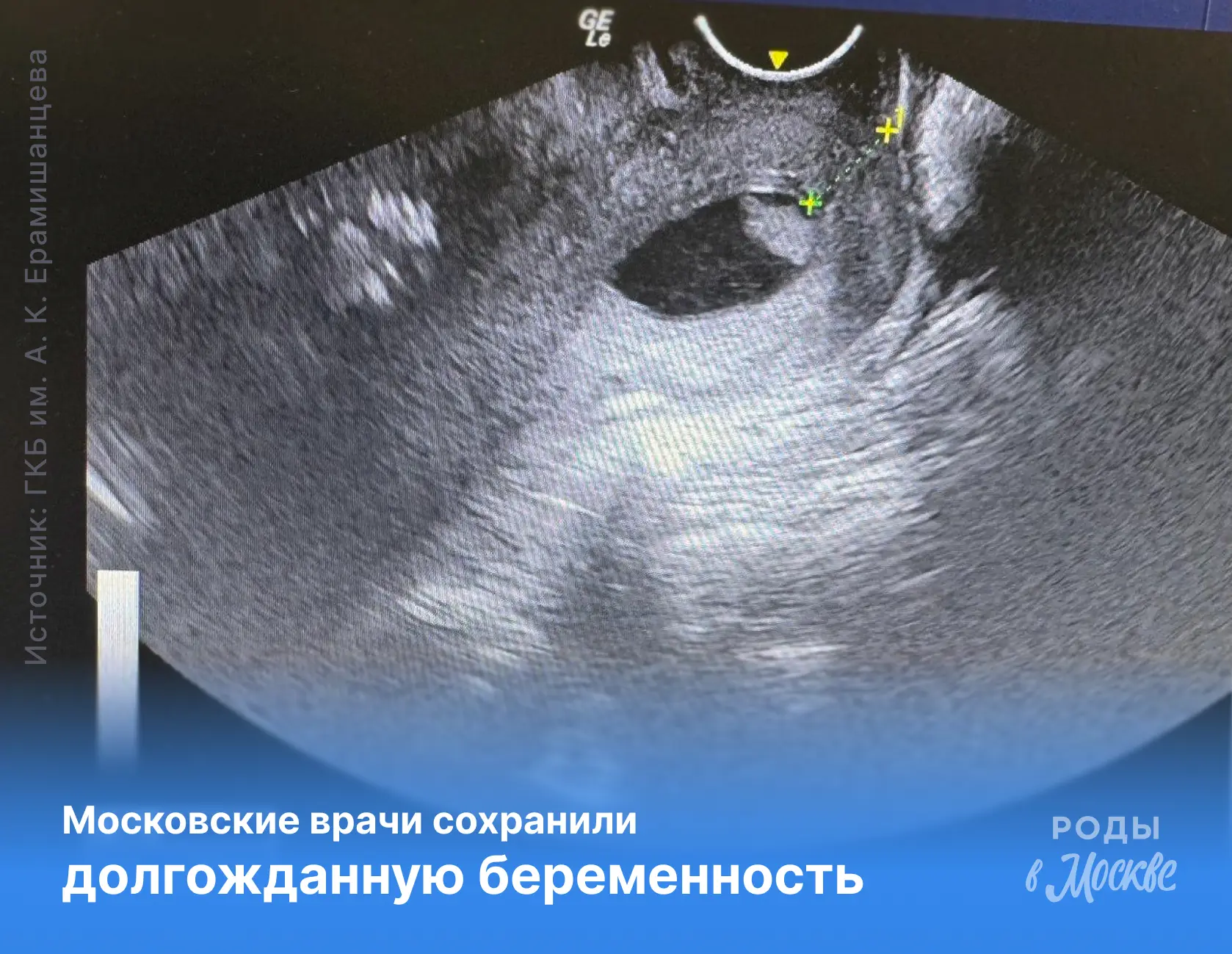 Московские врачи помогли сохранить беременность с множеством осложнений