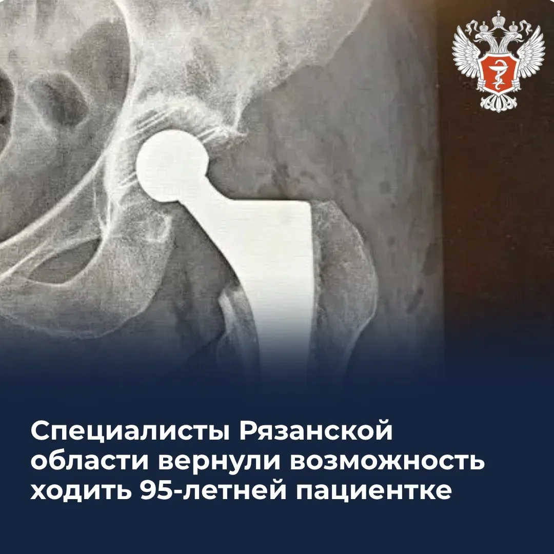 👵 Специалисты Рязанской области вернули возможность ходить 95-летней пациентке   Женщина поступила в