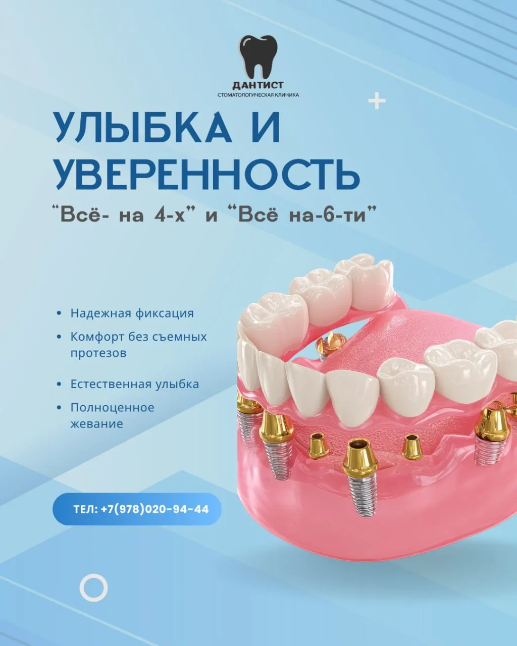 🦷 Всё-на-4 и Всё-на-6 — современное решение для полной улыбки

Если вы устали от неудобных съёмных 