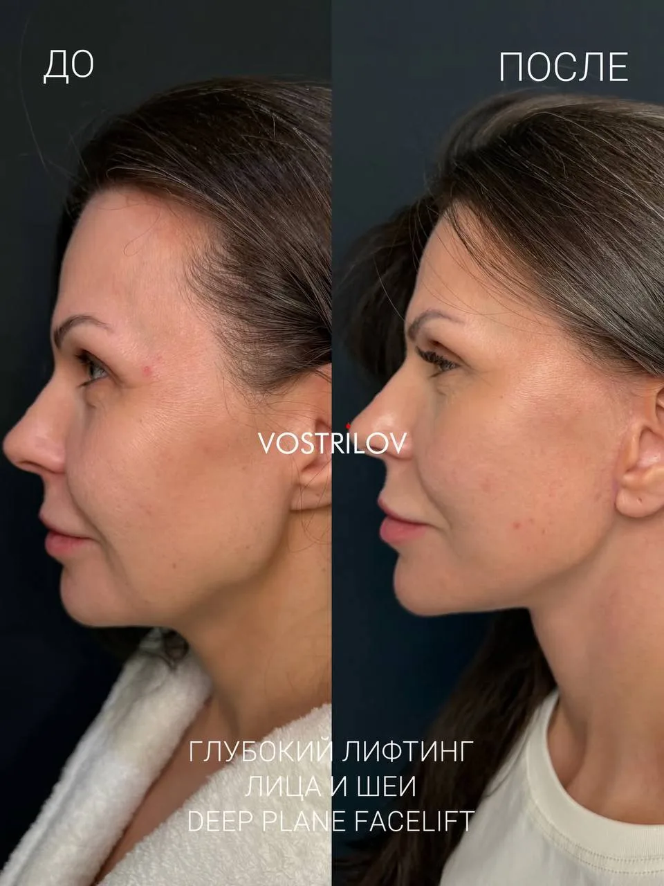 ✨Идеальный результат после глубокого лифтинга лица и шеи - deep plane facelift & necklift