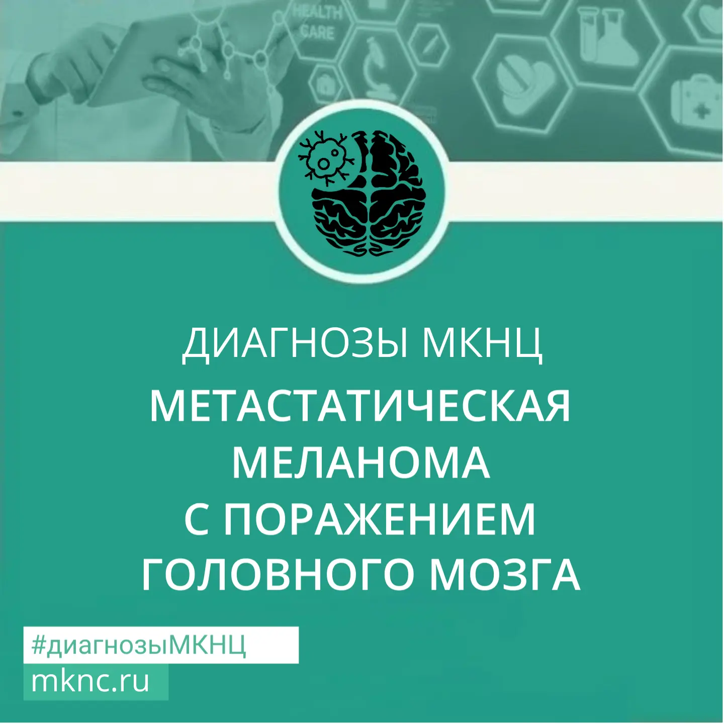 Меланома — это агрессивный вид рака кожи. «Метастатическая» означает, что болезнь распространилась и