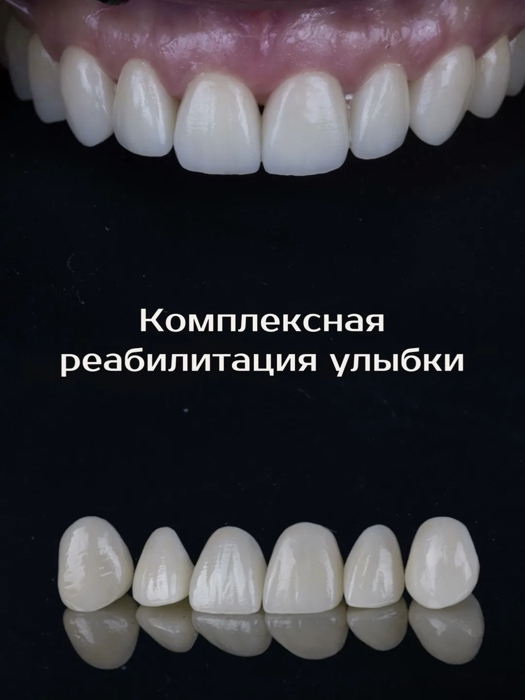 Путь к этому результату занял около 1,5 лет и включал в себя ортодонтическое лечение на брекет-систе