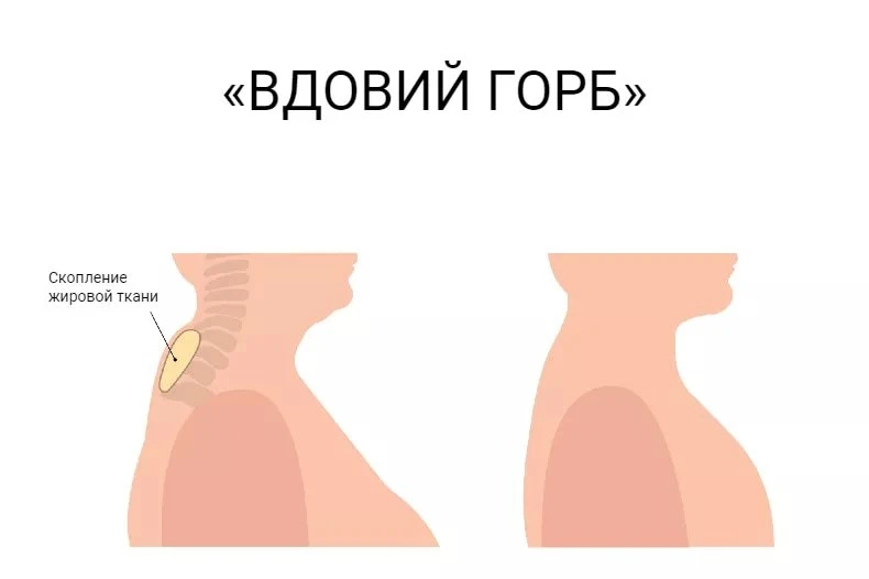 Вдовий горб (холка) — это не просто эстетический дефект, а жировое образование, которое...