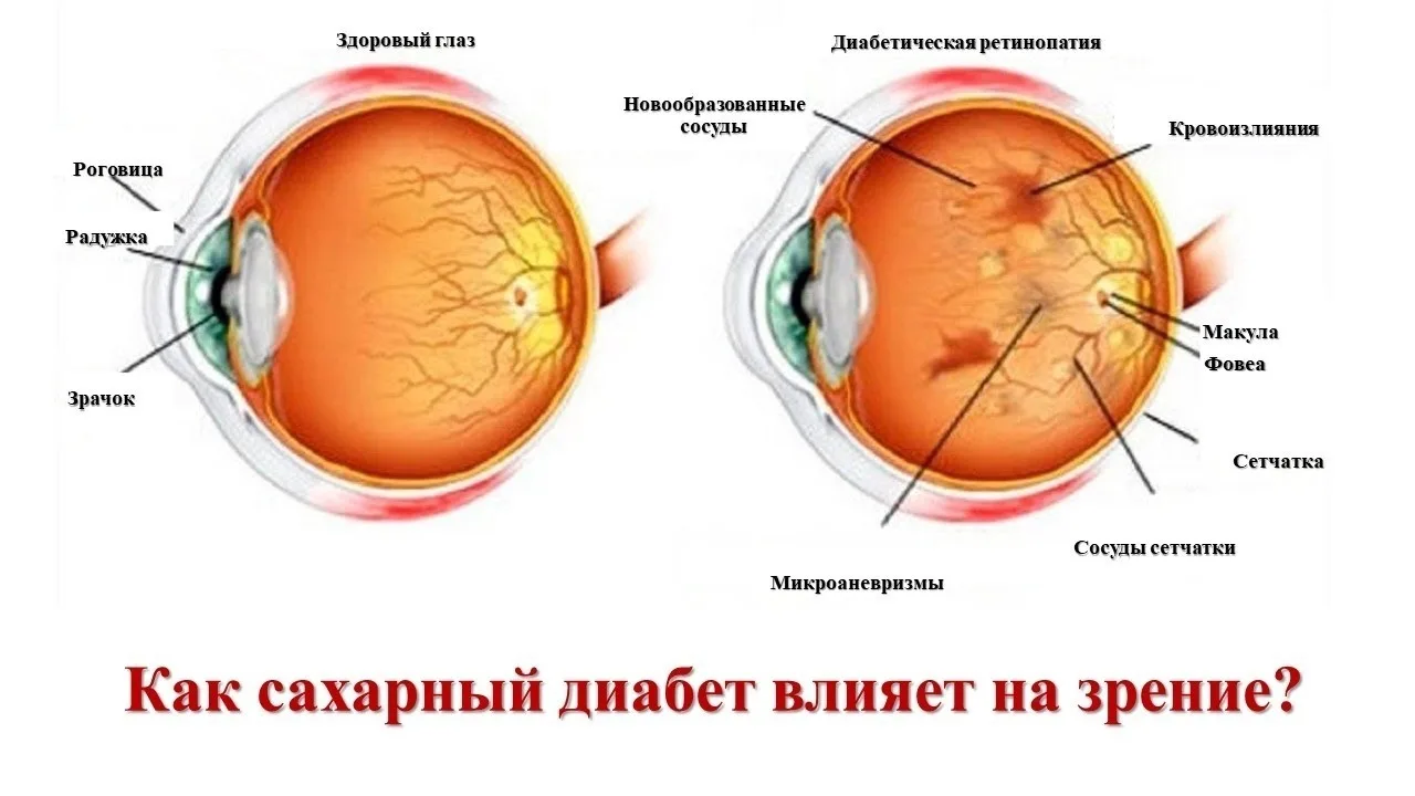 При сахарном диабете в той или иной степени страдают все структуры глаза. Диабетические...