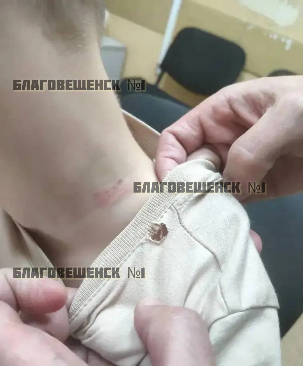 Скандал в благовещенской прогимназии: педагог проявила агрессию к ребенку — на шее остался кровоподт