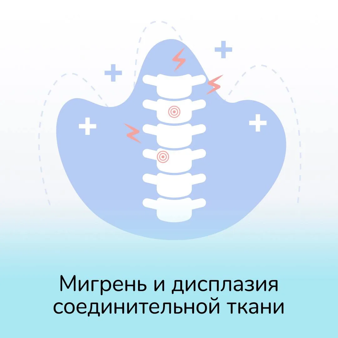Мигрень и дисплазия соединительной ткани  На определённом этапе своей практики я заметила: магний и 