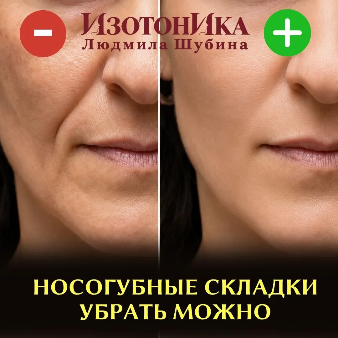 Сначала линия от крыла носа к уголку рта видна только при улыбке. Потом она остаётся и ...