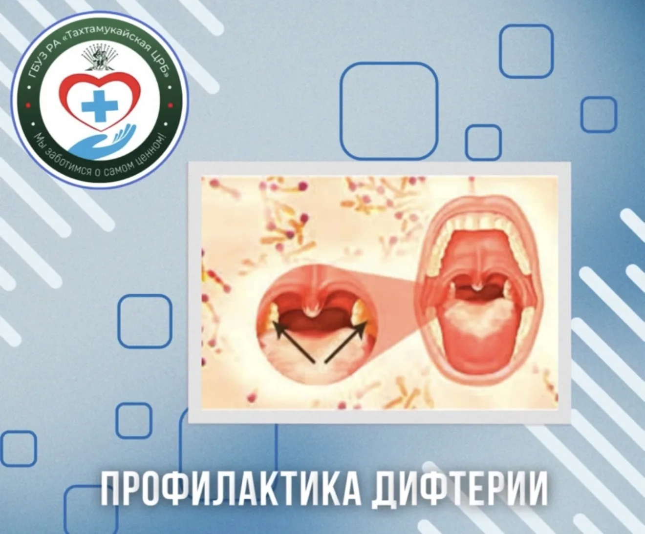 🔴Дифтерия – бактериальное инфекционное заболевание, характеризующееся преимущественным...