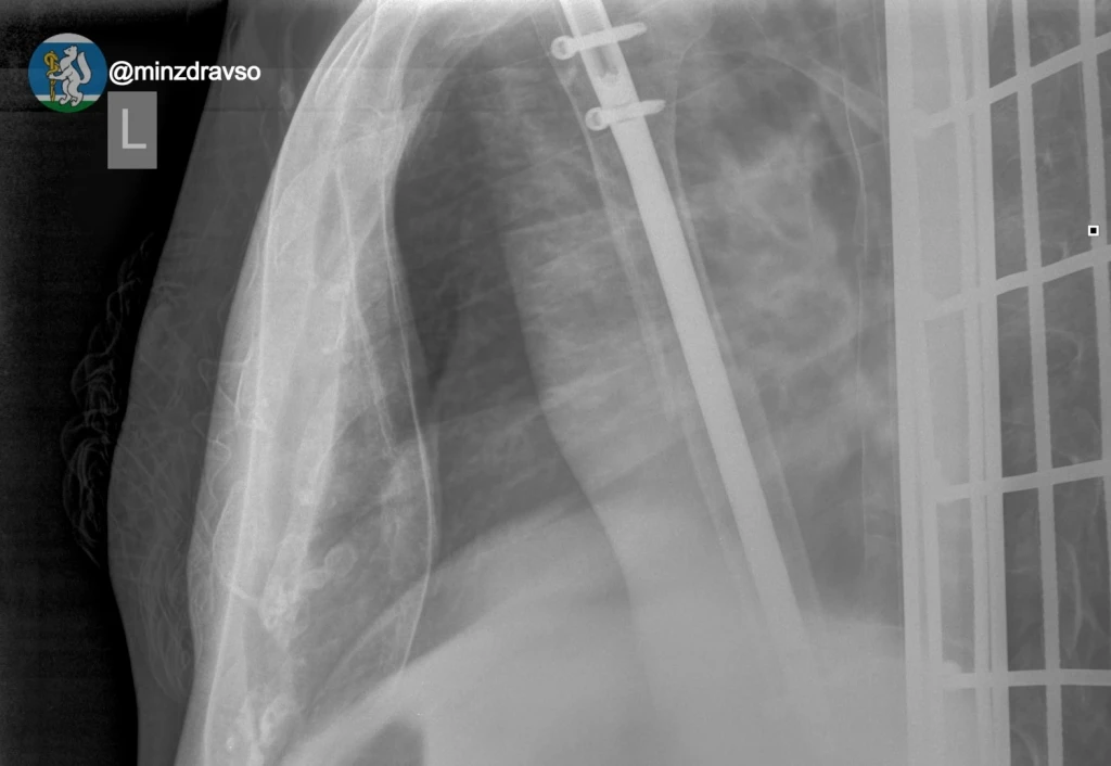 🚑 Слаженная работа свердловских врачей и серия сложнейших операций спасли 81-летнюю па...
