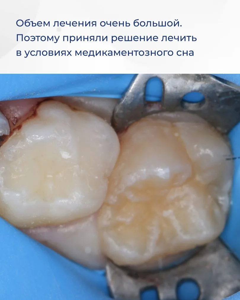 Недостаточно тщательная домашняя гигиена может привести к множественному поражению зубов. Именно это