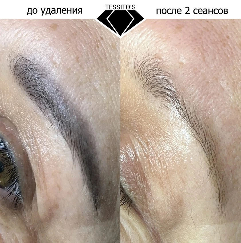 Многие откладывают удаление перманента, потому что боятся шрамов, жутких корочек и необ...