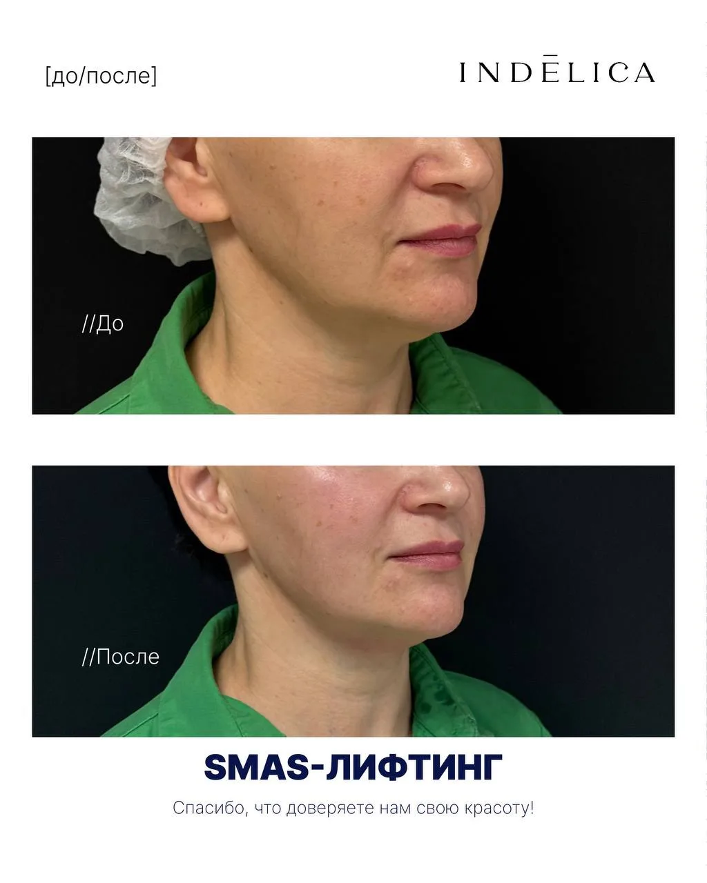 Чёткий овал и подтянутая кожа — без операции 👆