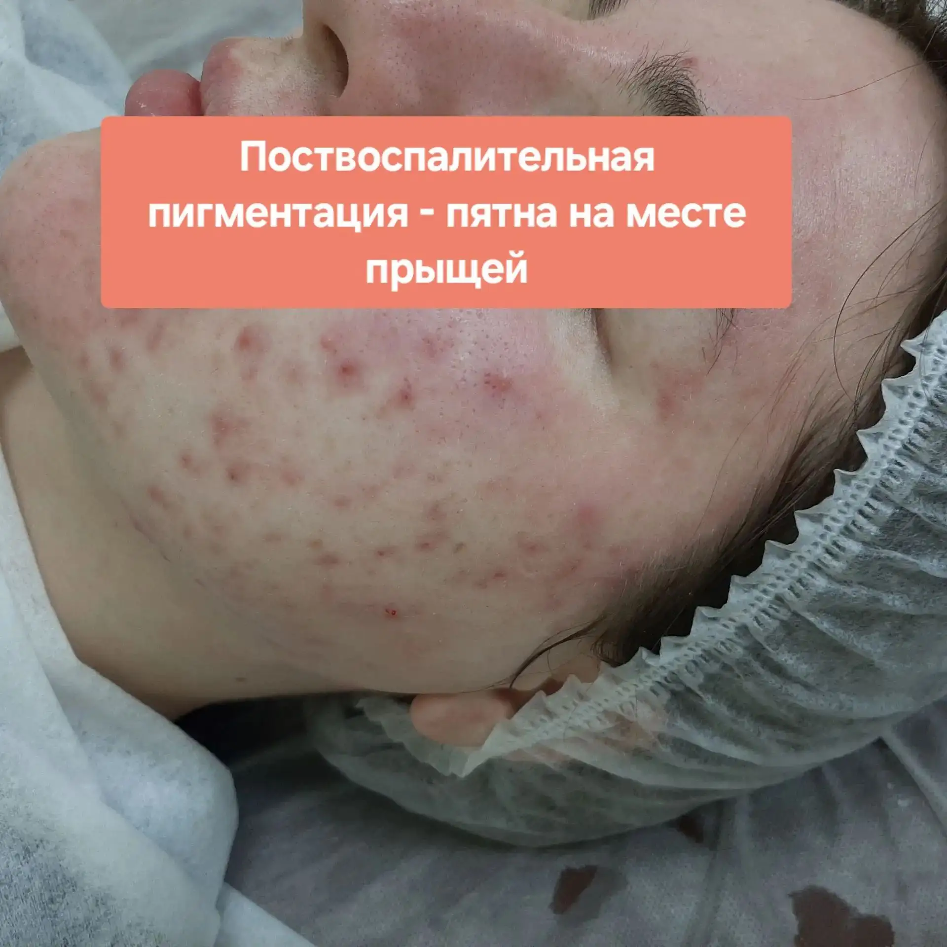 Многих моих пациенток огорчают пятна и уплотнения, которые долго остаются  после воспал...