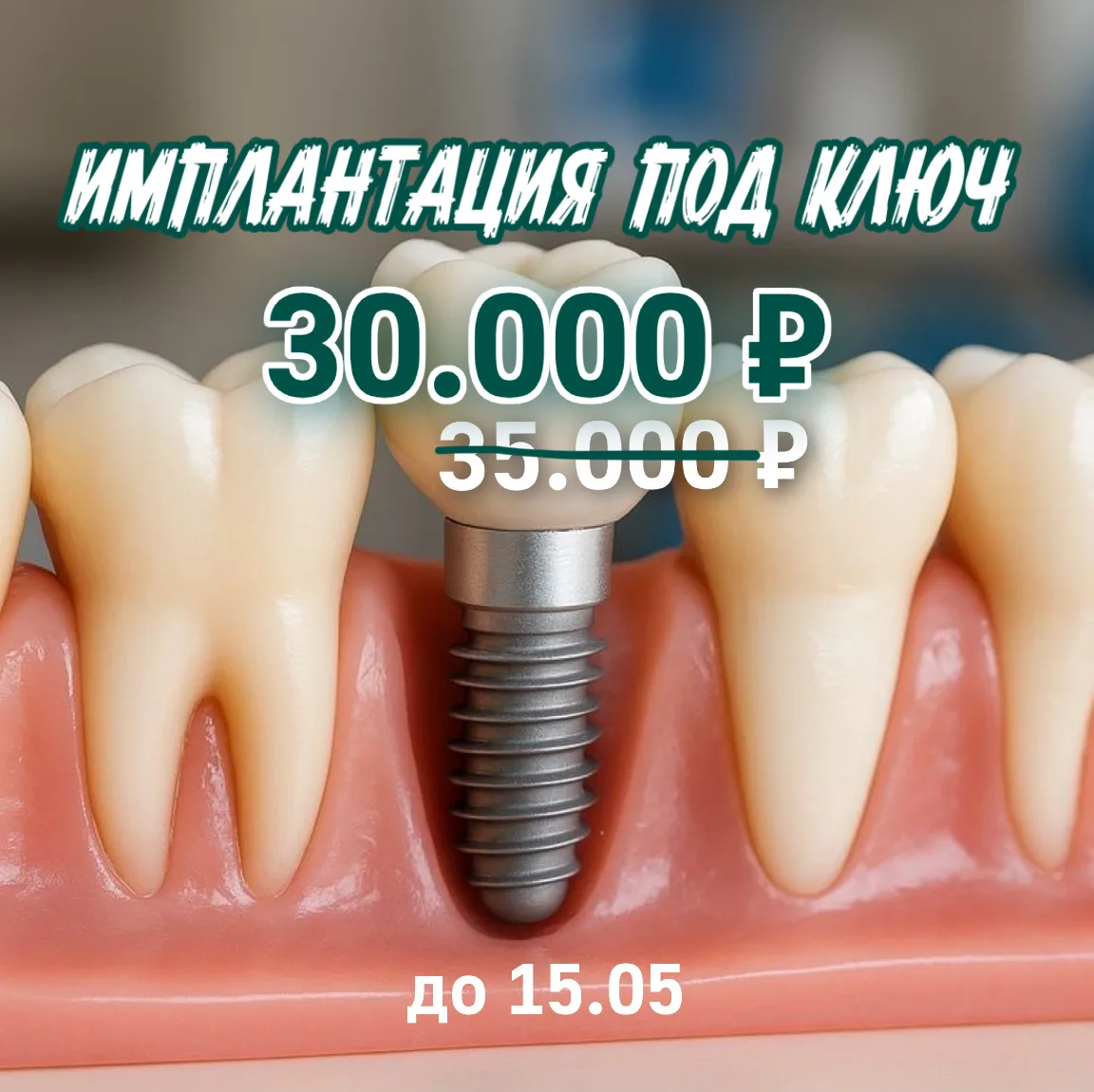 Имплантация Osstem «под ключ» — 30 000 ₽ вместо 35 000 ₽ в ПрофДентал!