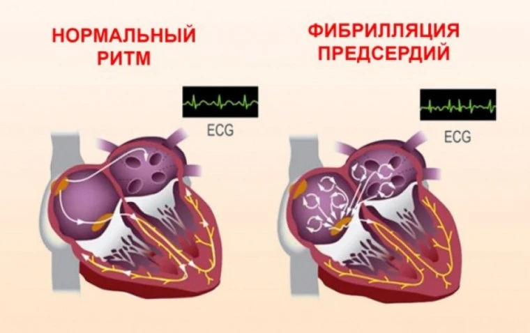 💓Фибрилляция предсердий (ФП) или мерцательная аритмия — это самая часто встречающаяся ...