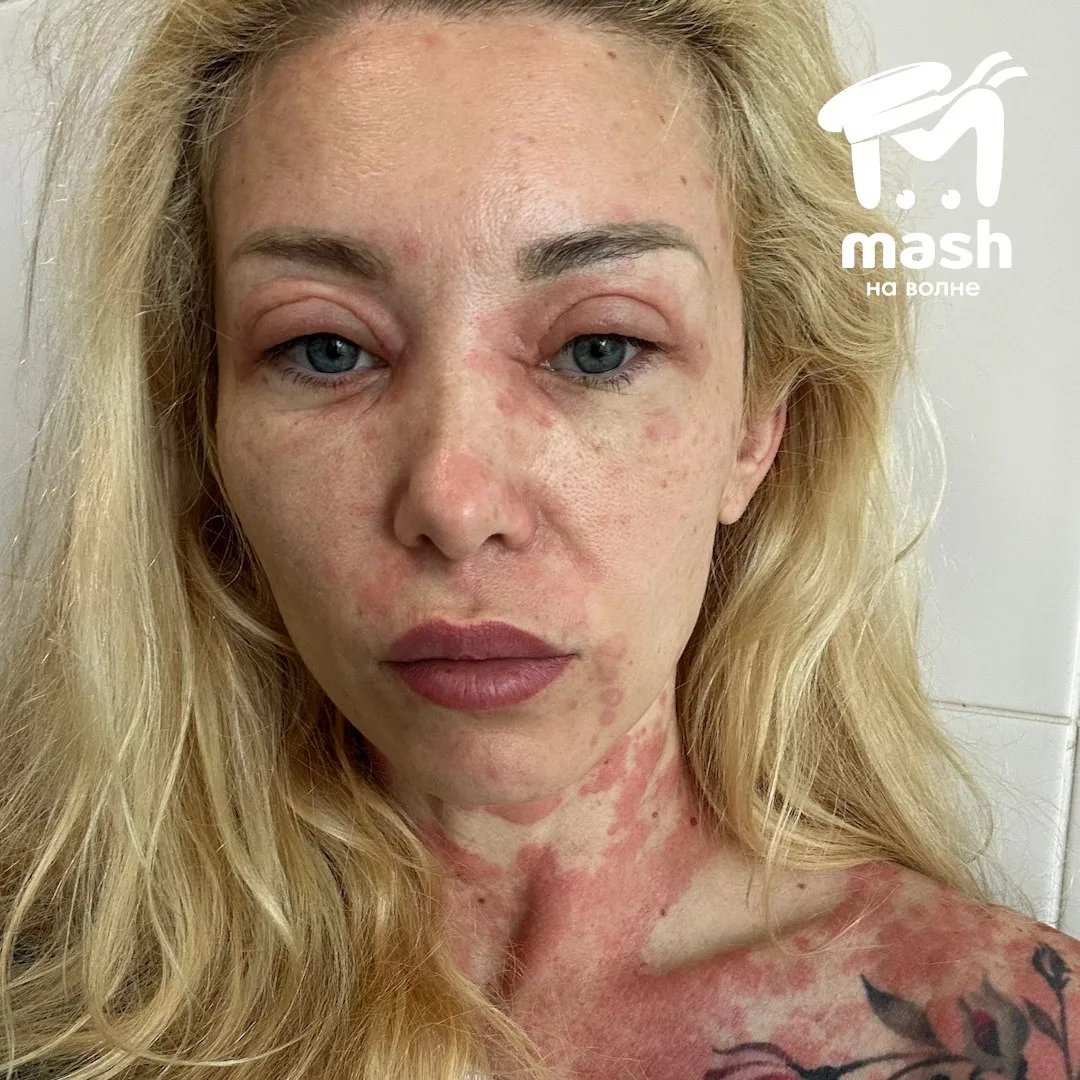 Дочь Мстислава Запашного попала в реанимацию с отеком Квинке во время отдыха в Севастополе.   Катя п