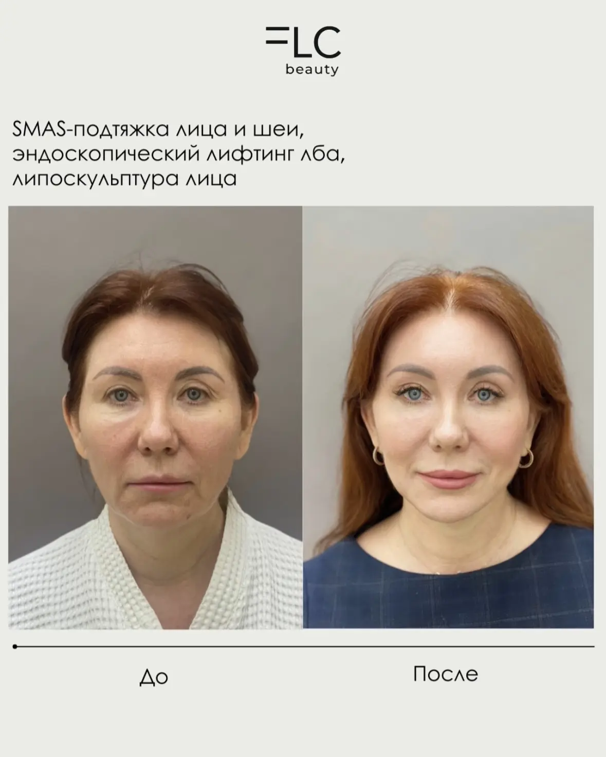 Результаты совмещения косметологии и пластической хирургии

Делимся с вами результатом нашей пациент