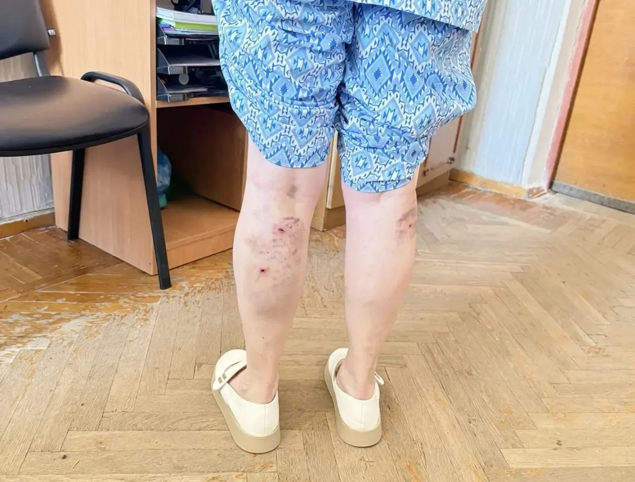 ❗️В Рубежном оперативно отреагировали на нападение группы безнадзорных собак. 

Пострадавшая жительн