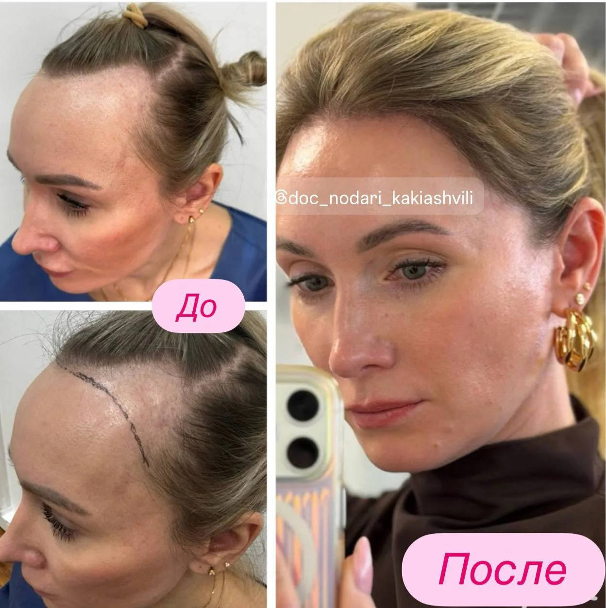 Еще один, новый и считаю отличный результат нашей пациентки Юлии.