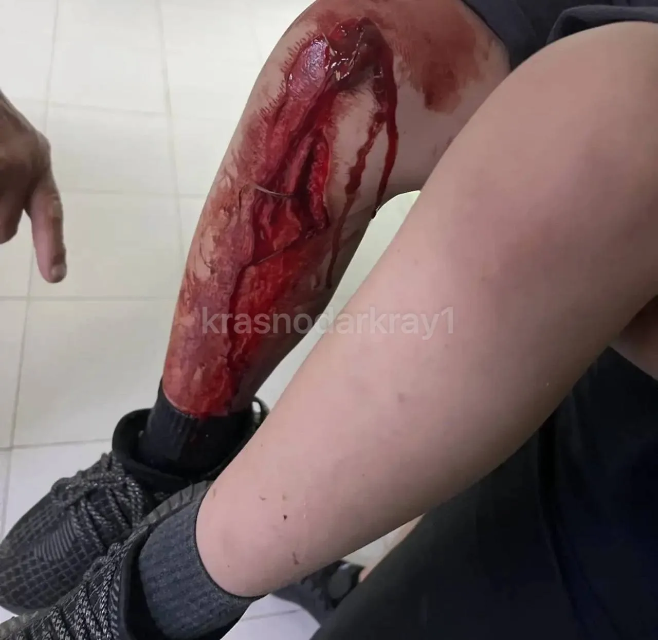 В хуторе Усатова Балка ребёнок получил серьёзную травму ноги после падения на залежи битого стекла р