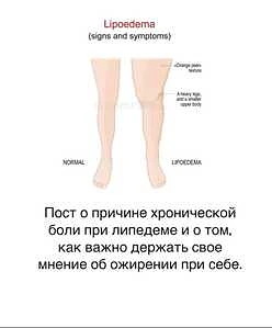 https://thixotraining.ru/forum/mezenrealizm-posty/post-o-prichine-hronicheskoj-boli-pri-lipedeme-i-o