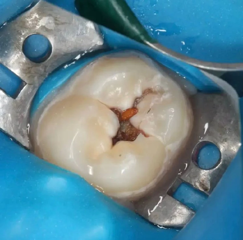 Несу вам очень интересный случай 🦷 🤓

От Кузнецовой АР 🩺

Дано: пациент 13 лет, зуб - 7ка
Вот что