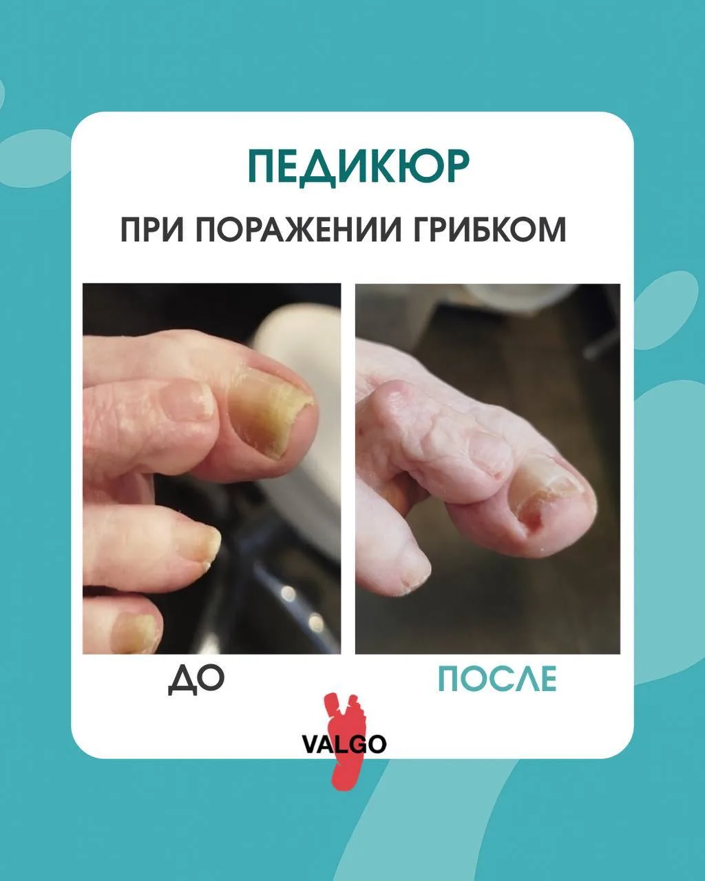 👣Возраст - не повод откладывать заботу о стопах.