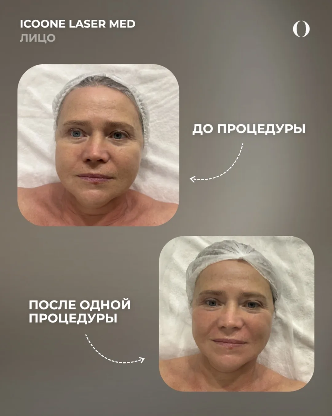 Результат одной процедуры Icoone Laser Med по лицу