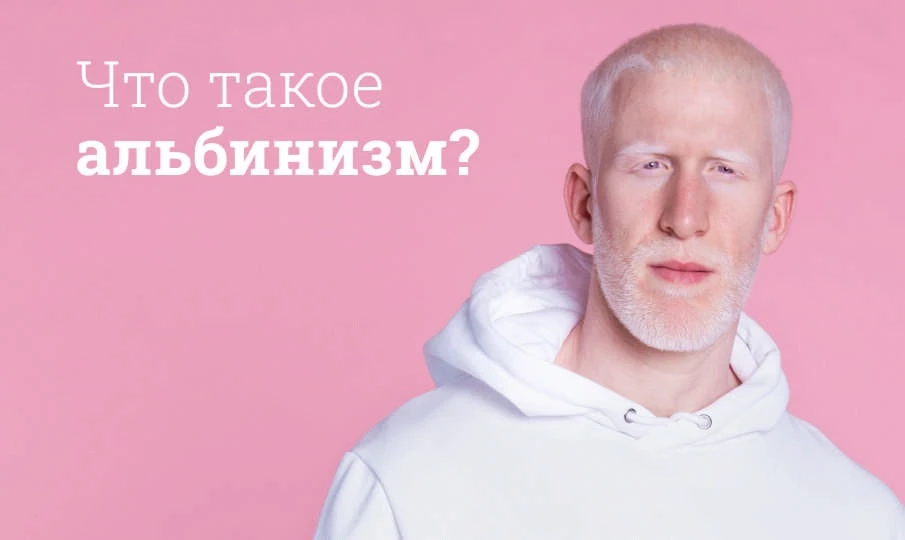 «Белые» люди: в чём причина альбинизма и как врачи помогают пациентам с этим редким заболеванием

Ка