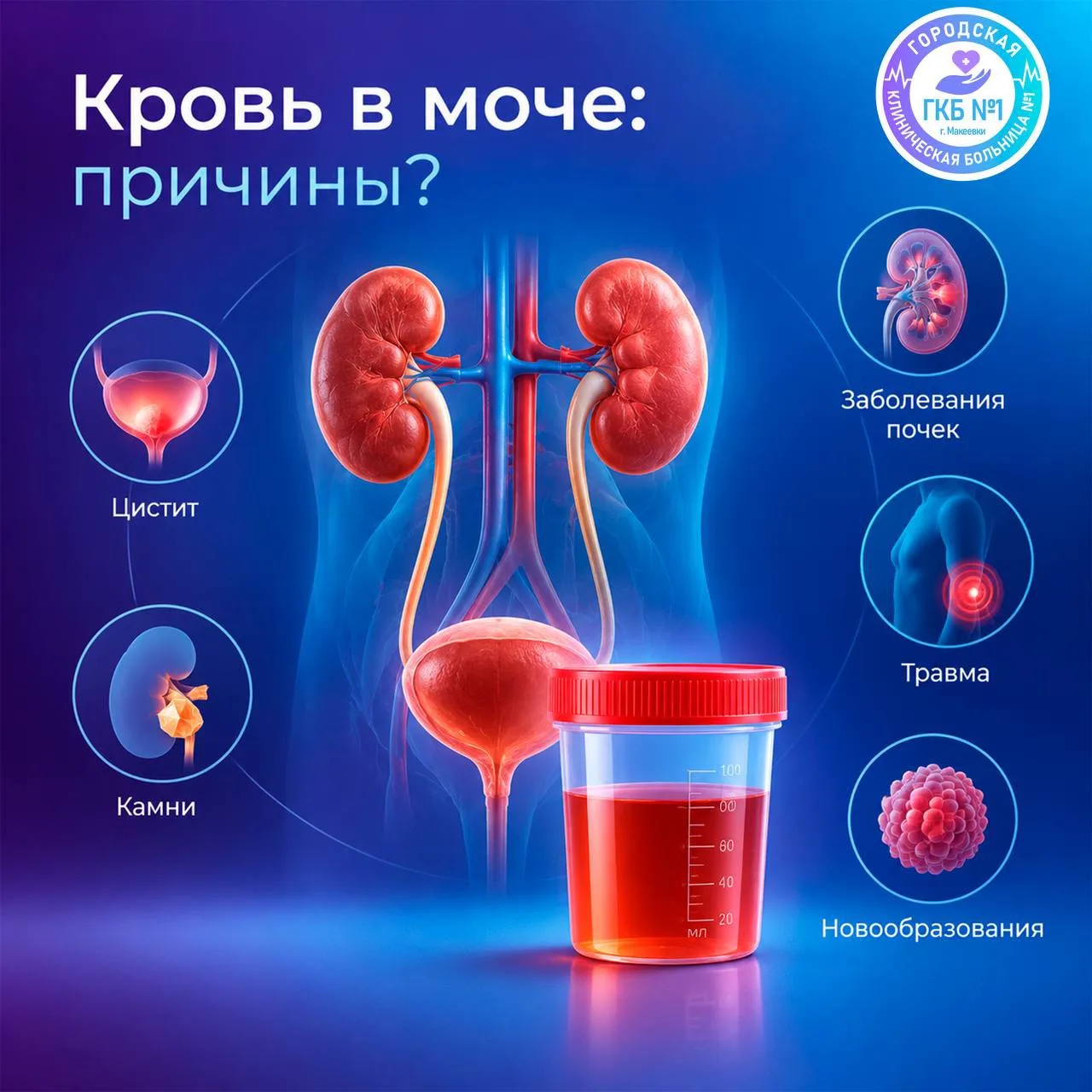 🩸 Кровь в моче (гематурия): почему это может происходить?