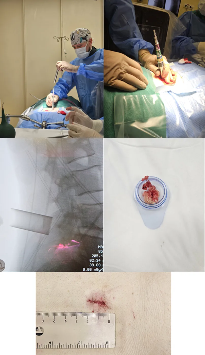 😷 💉Из операционной — домой за 2 дня: возможности малоинвазивной хирургии.  Сильные боли в ноге, при 