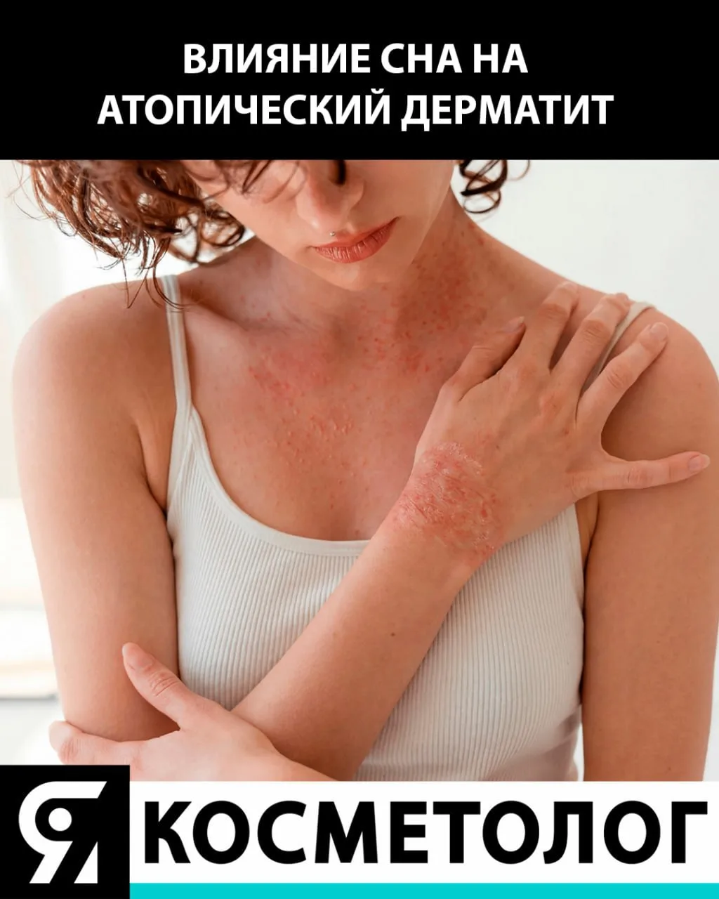 Атопический дерматит, качество сна и качество жизни