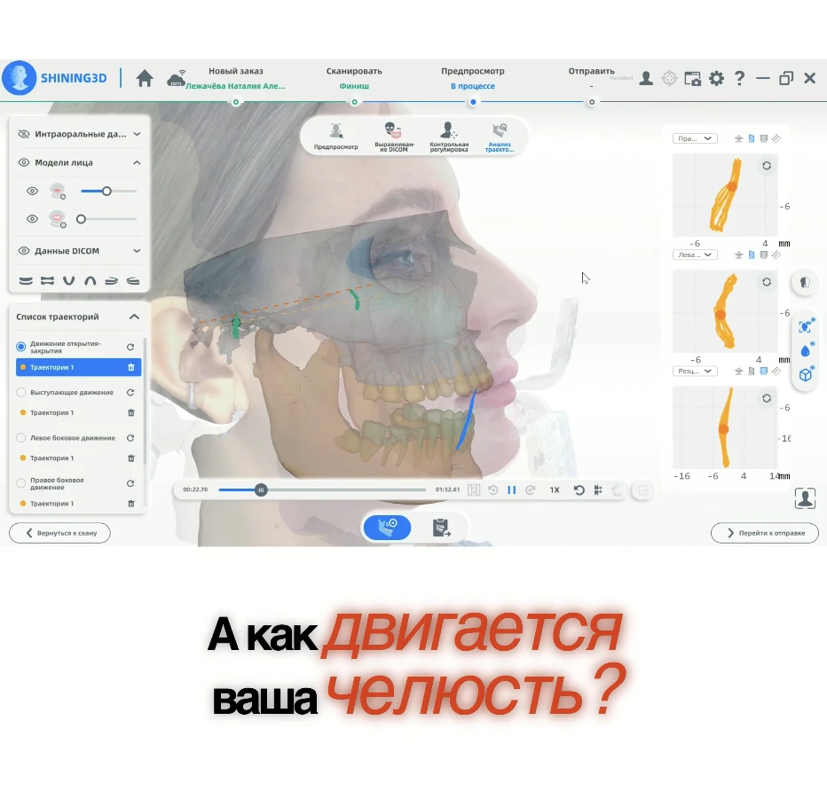 Новые зубы ровные и красивые, а жевать неудобно - почему важно учитывать движения челюс...