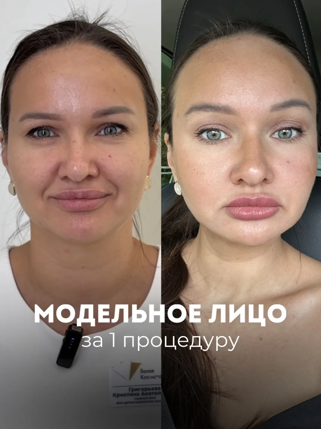 Лифтинг лица без операции🔥