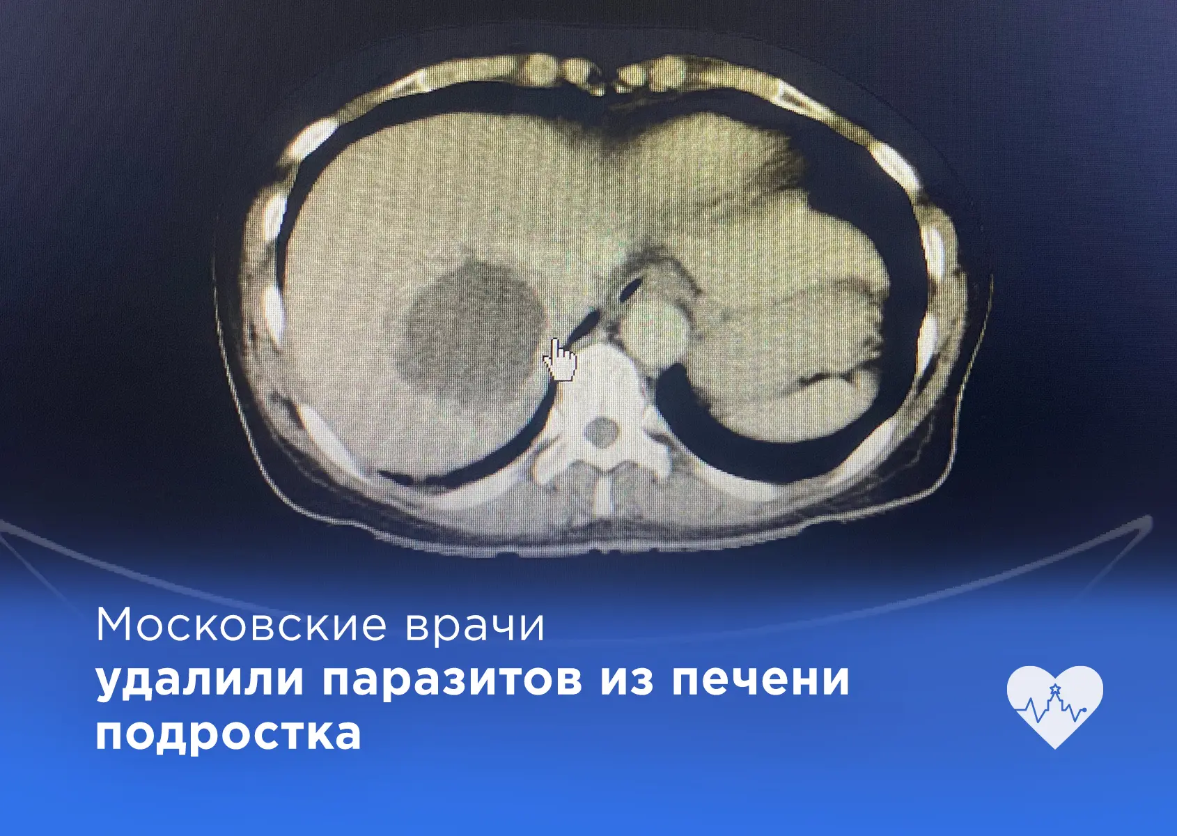 Более 100 капсул с паразитами удалили из печени подростка

В ДГКБ им. Г. Н. Сперанского поступил 16-