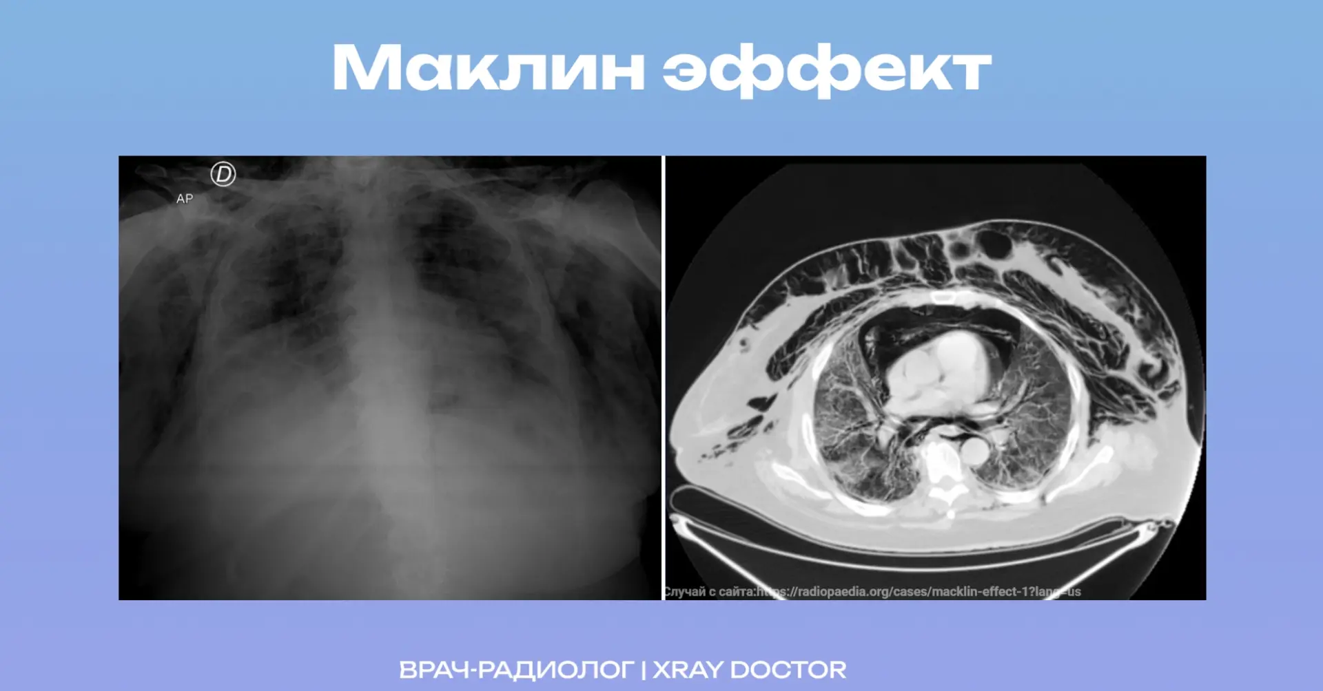 Правильный ответ на вчерашний мозговой штурм: эффект Маклина🌪