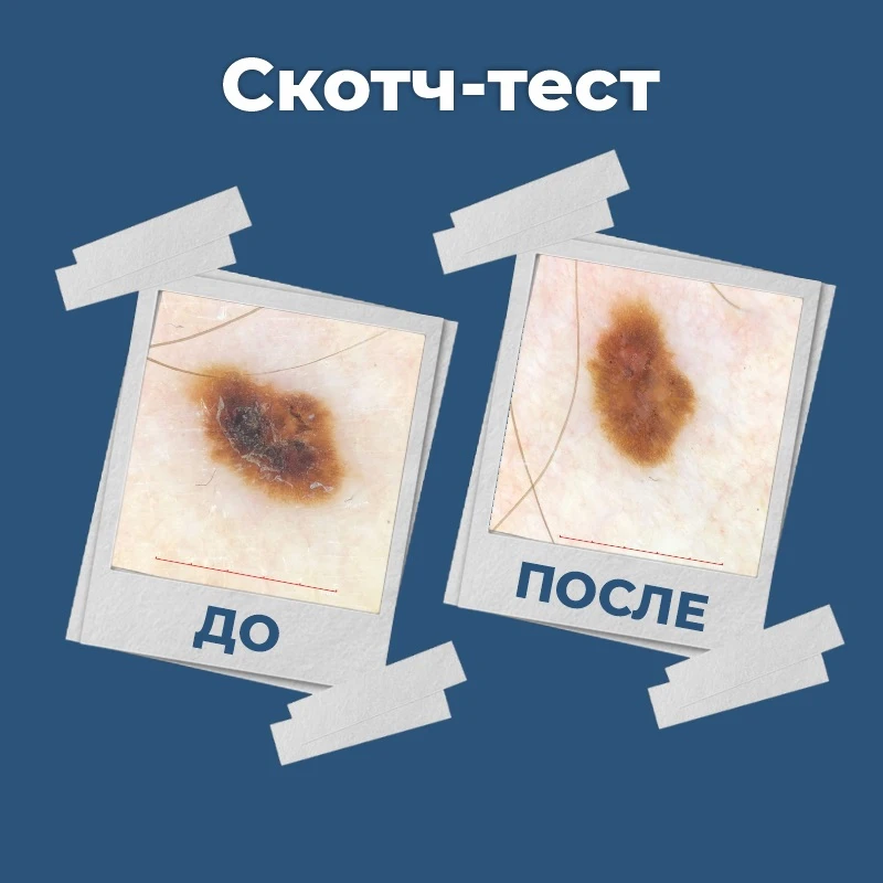 👩🏼‍⚕️ Иногда наши врачи используют дерматоскопические лайфхаки в своей работе.
