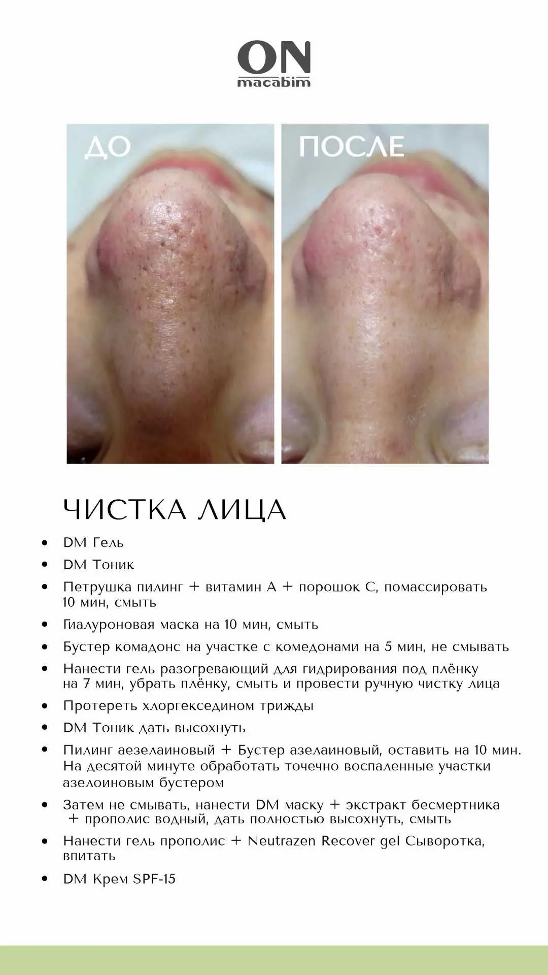 КЕЙС «ЧИСТКА ЛИЦА» НА КОСМЕЦЕВТИКЕ ONMACABIM ОТ КОСМЕТОЛОГА