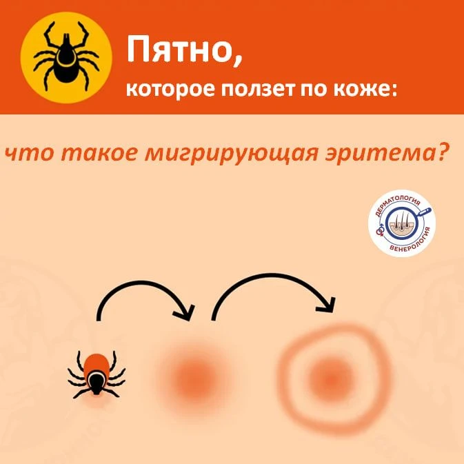 Вы когда-нибудь слышали, чтобы пятно на коже… переезжало? 🧳🔄