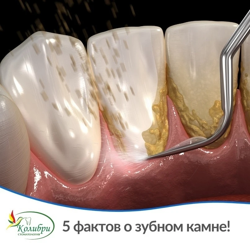 5 фактов о зубном камне!