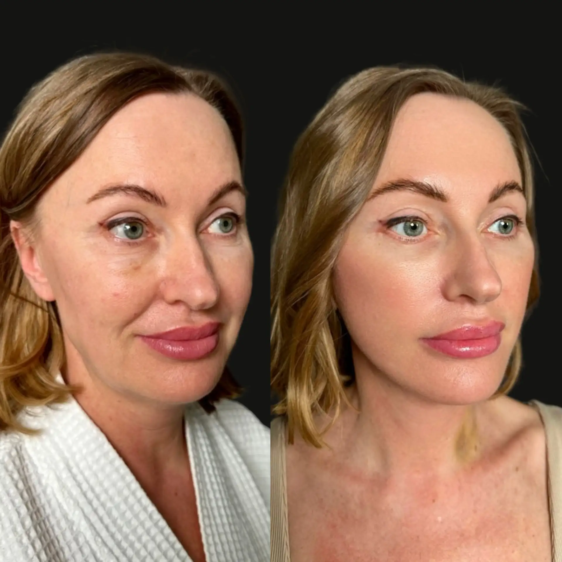 Deep plane facelift и нижняя жиросберегающая блефаропластика с коррекцией носослёзных б...
