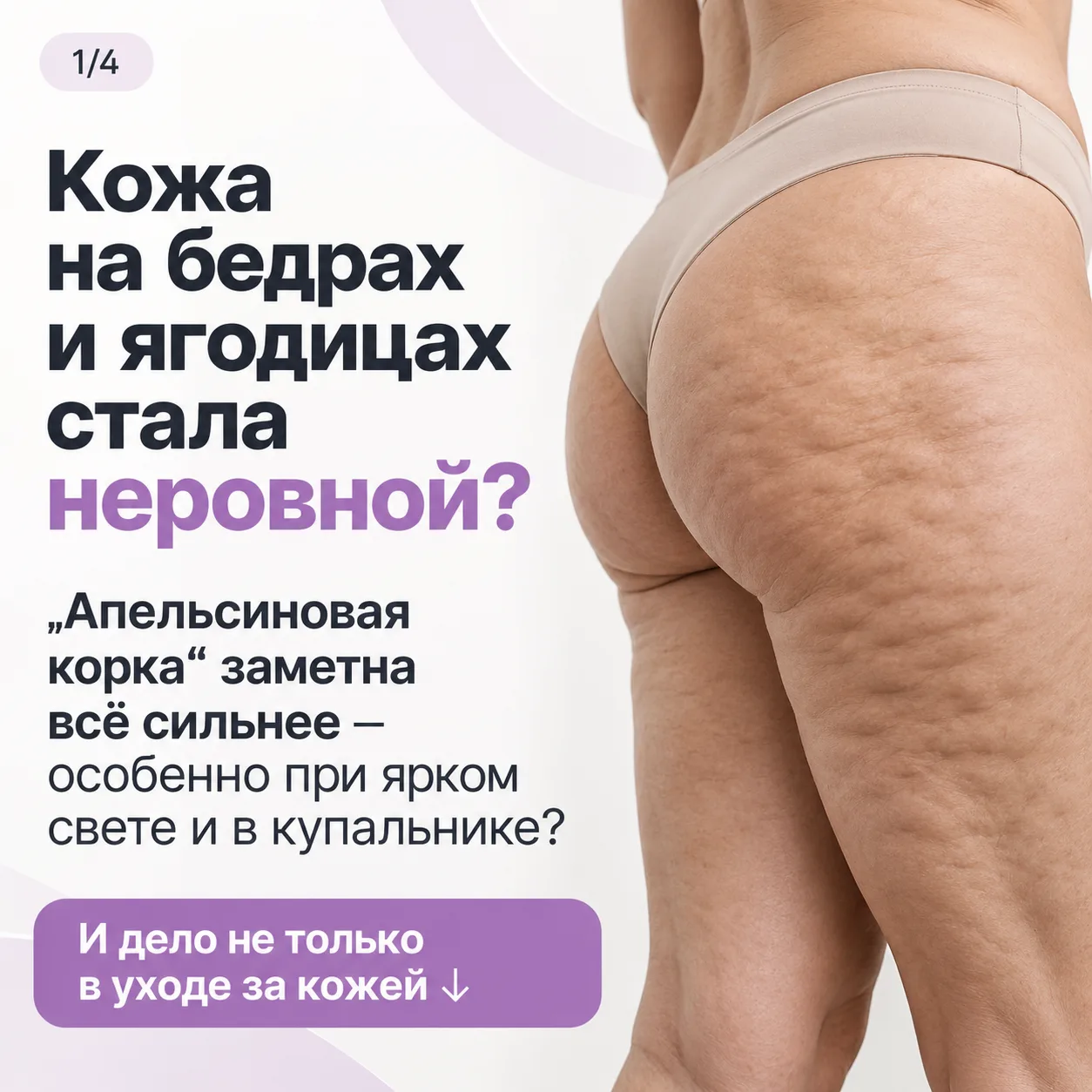 😭Почему целлюлит становится заметнее — даже если вы ухаживаете за кожей