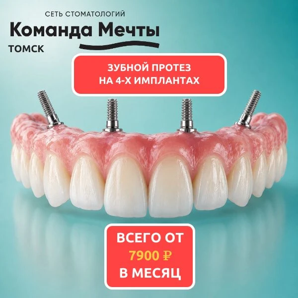 Несъёмное протезирование зубов на 4-х имплантах в Томске