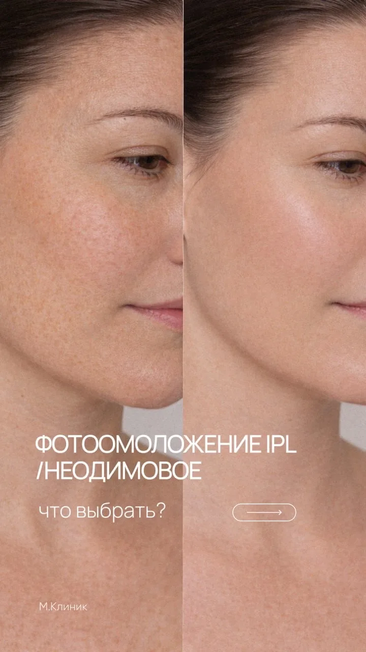 Фотоомоложение IPL или Неодимовое: что выбрать?

Мы не будем хвалить одно и ругать другое. У нас в к