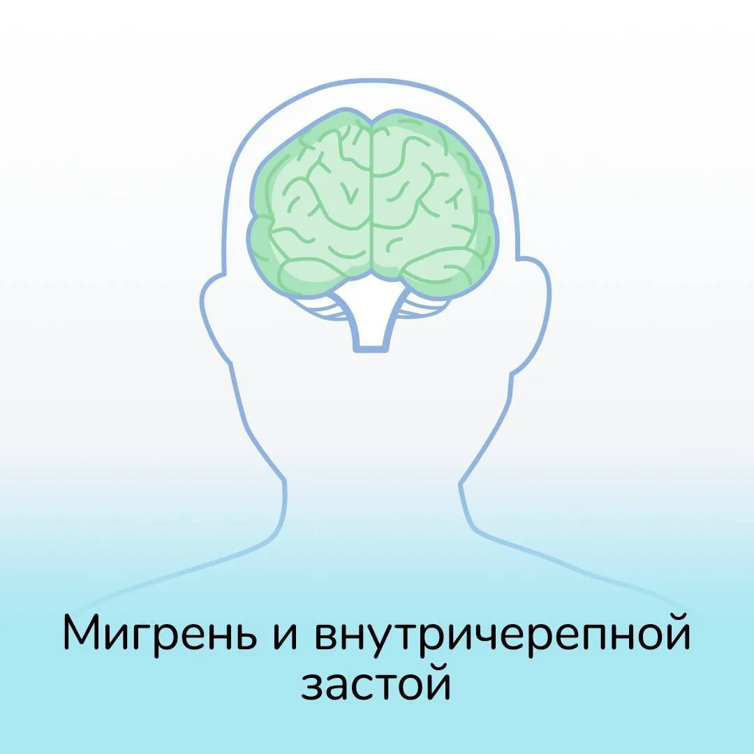 Мигрень и внутричерепной застой  Ещё в студенчестве моя первая научная работа была посвящена головны
