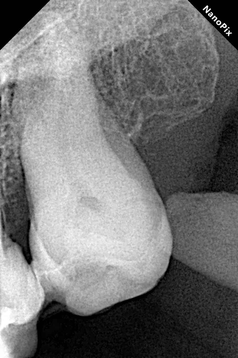 🦷 То самое ощущение, когда ты открываешь зуб после аутотрансплантации и понимаешь, что...